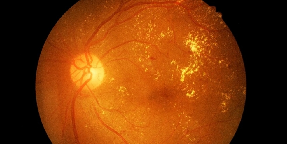 Screening op diabetische retinopathie, what's new?