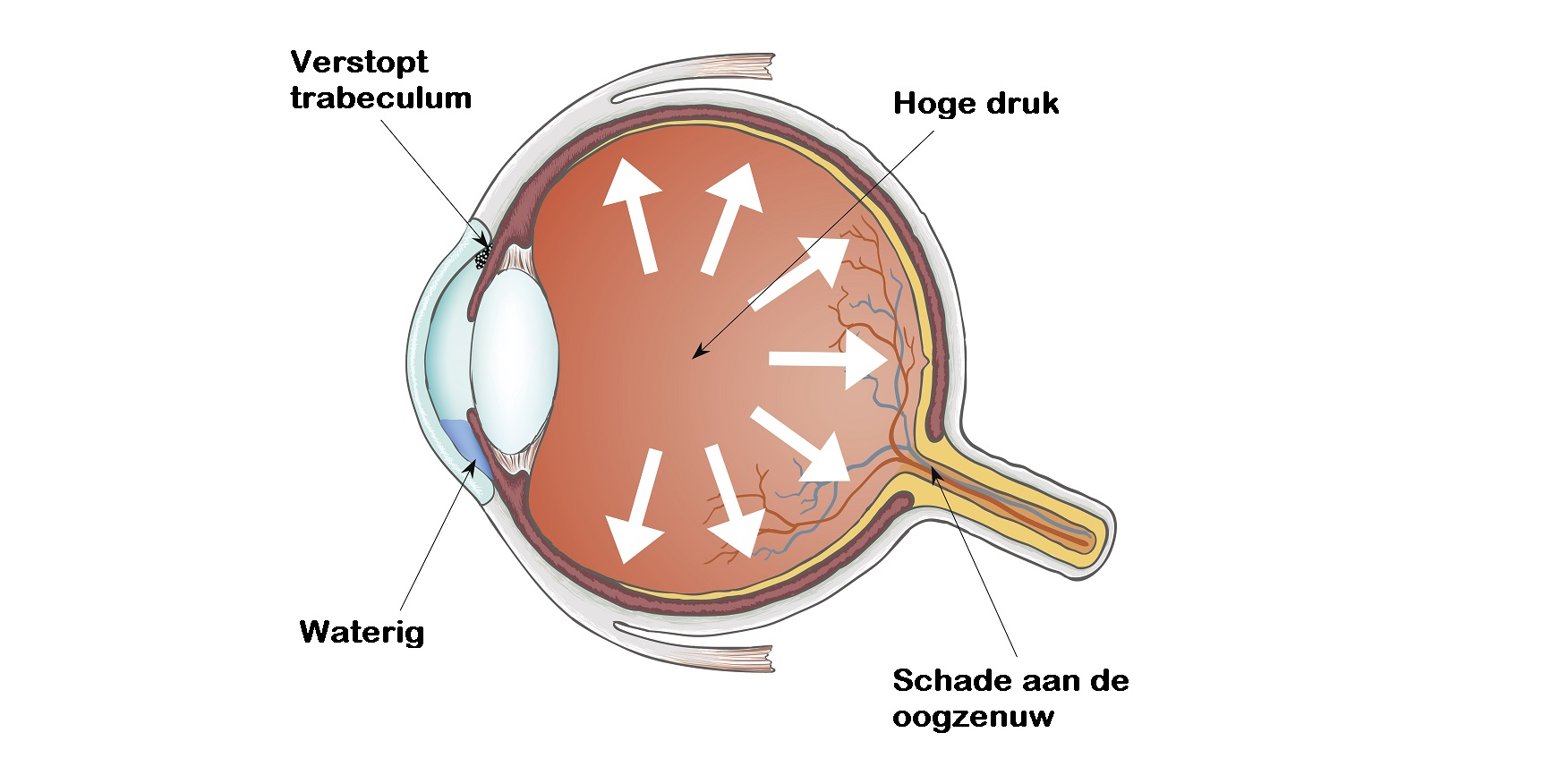 Глаукома латынь. Глаукома схема.